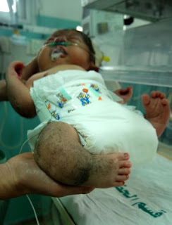 Malformations congénitales à Gaza : prévalence, types, éléments familiaux et corrélation avec des facteurs environnementaux